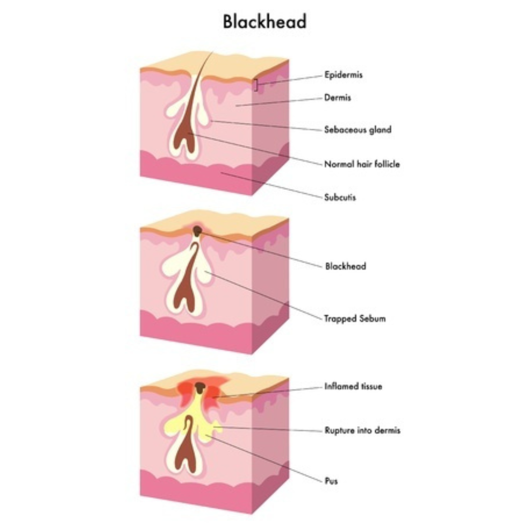 Acne/Rosacea Amino Acid